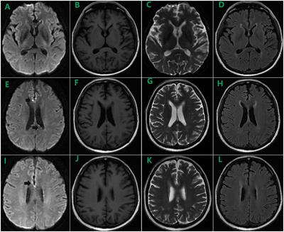Dynamic findings of brain magnetic resonance imaging in a haploidentical hematopoietic stem cell transplantation recipient with cytomegalovirus ventriculoencephalitis: a case report and systematic review
